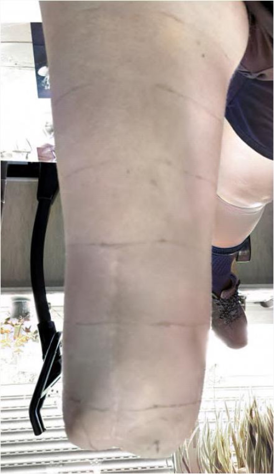 Sensitive Condyles &mdash; Limb