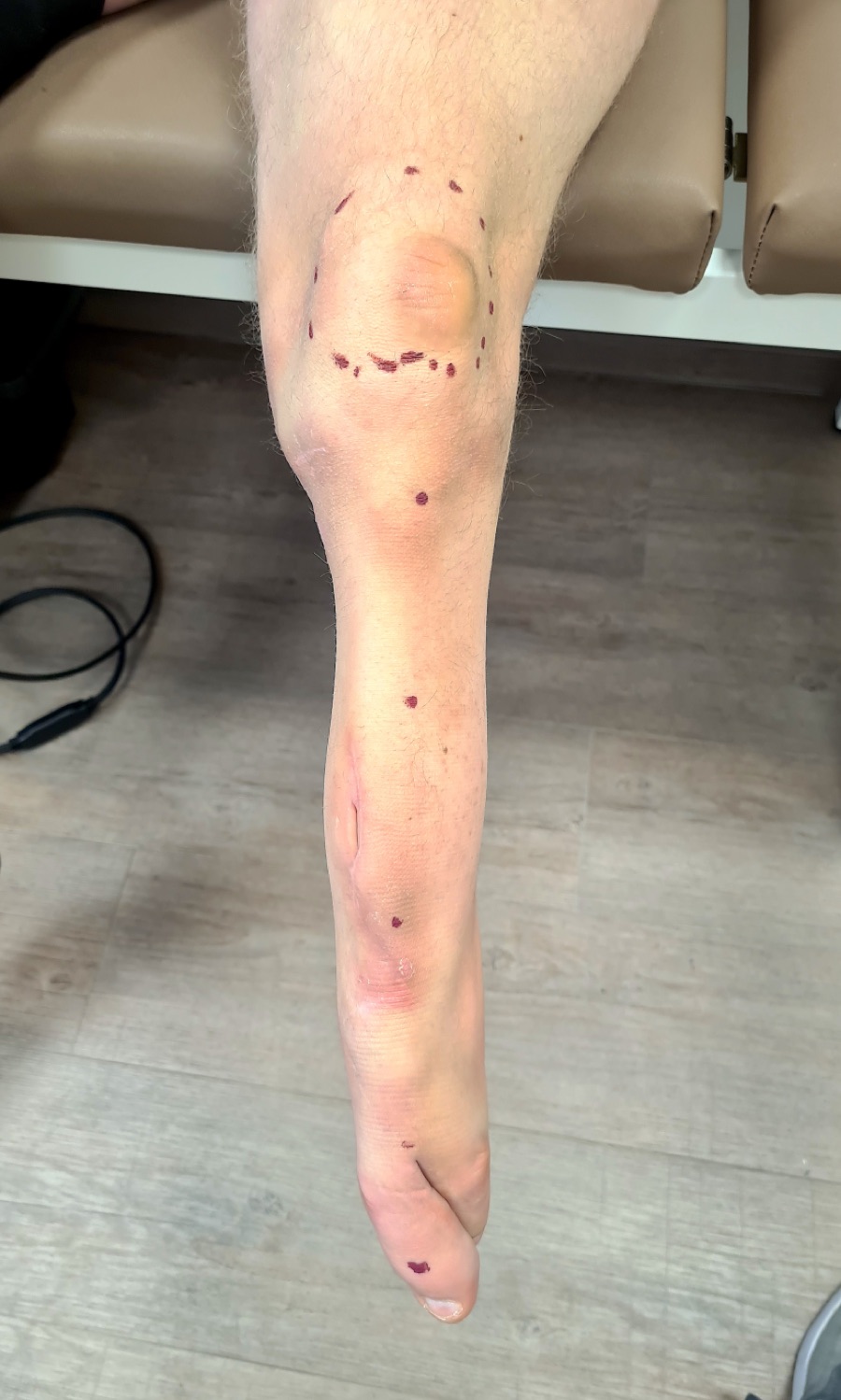 Congenital &mdash; Limb