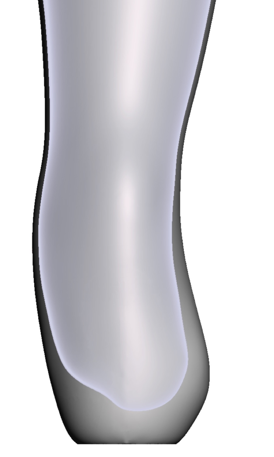 Exostosis &mdash; 3D Model
