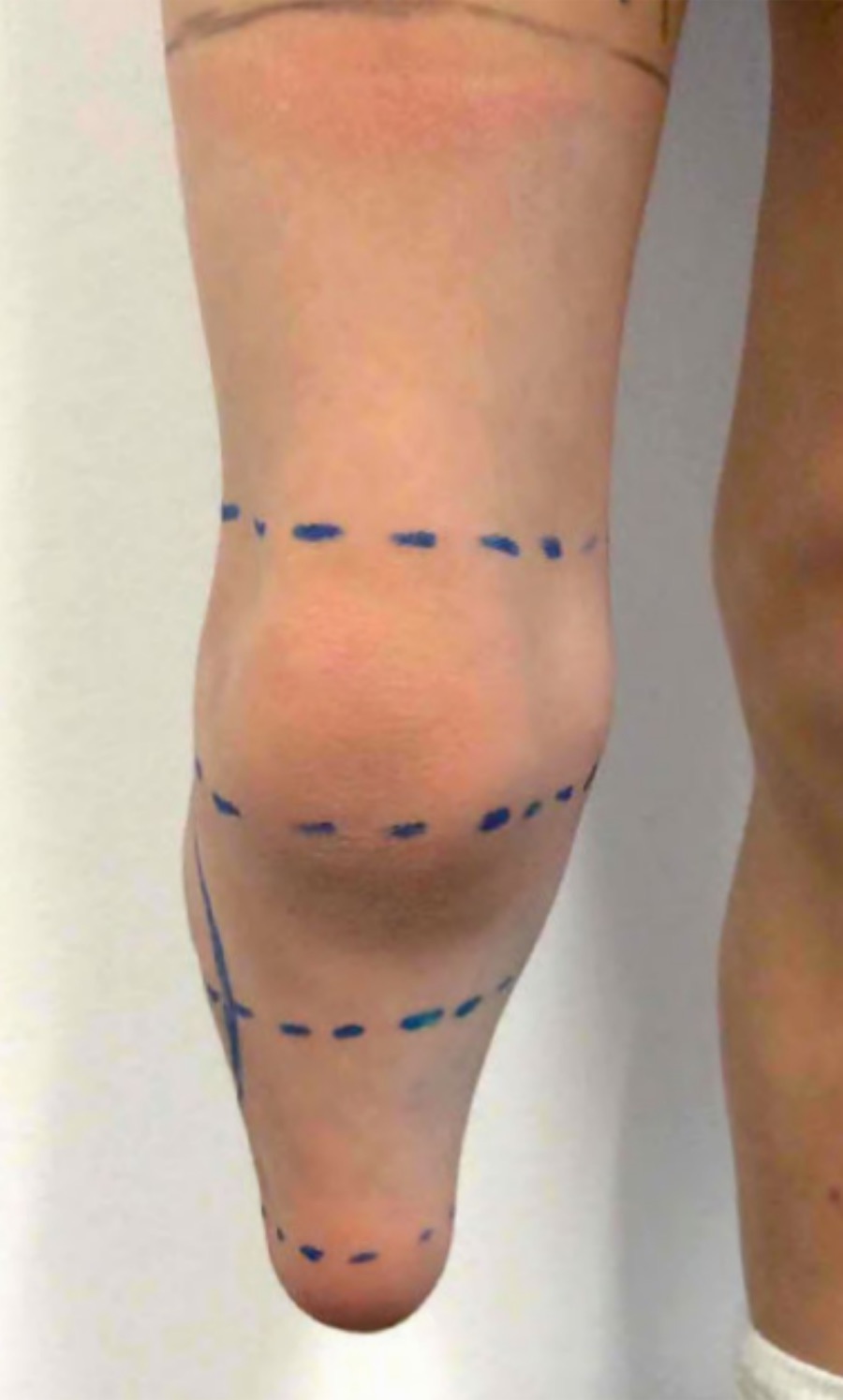 Pediatrics / XXS &mdash; Limb