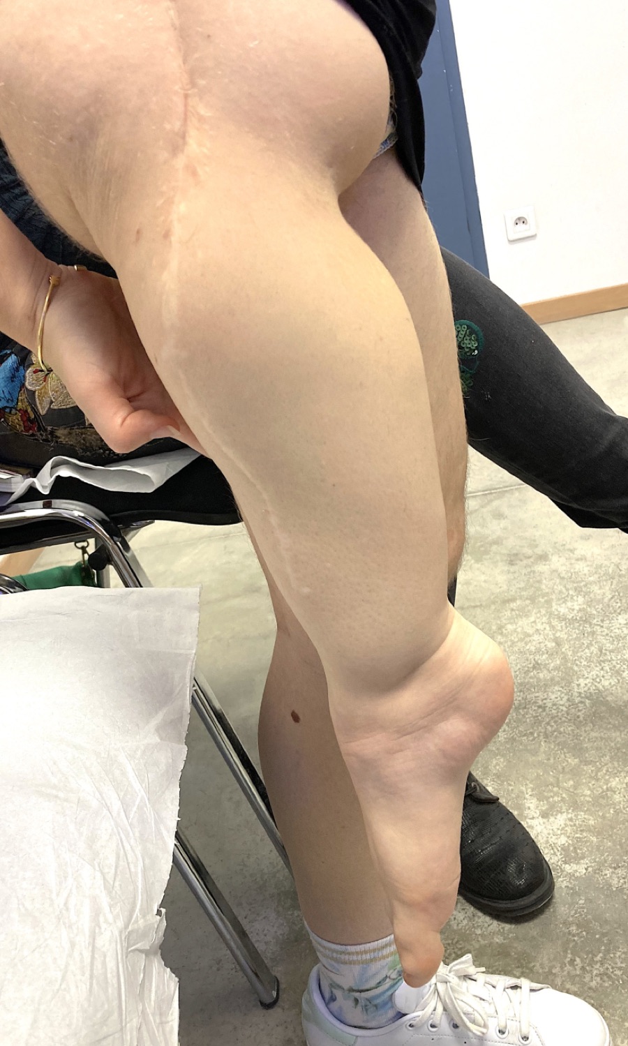 Rotationplasty &mdash; Limb