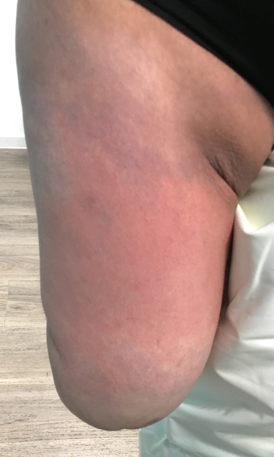Sensitive Adductor &mdash; Limb
