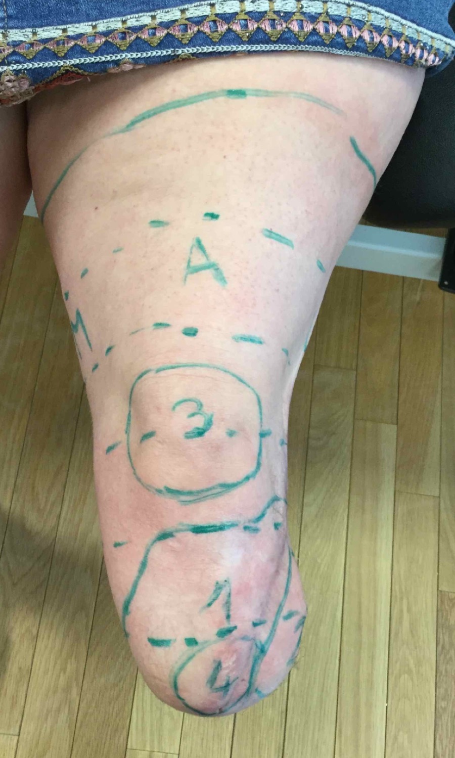 Conical Thigh &mdash; Limb