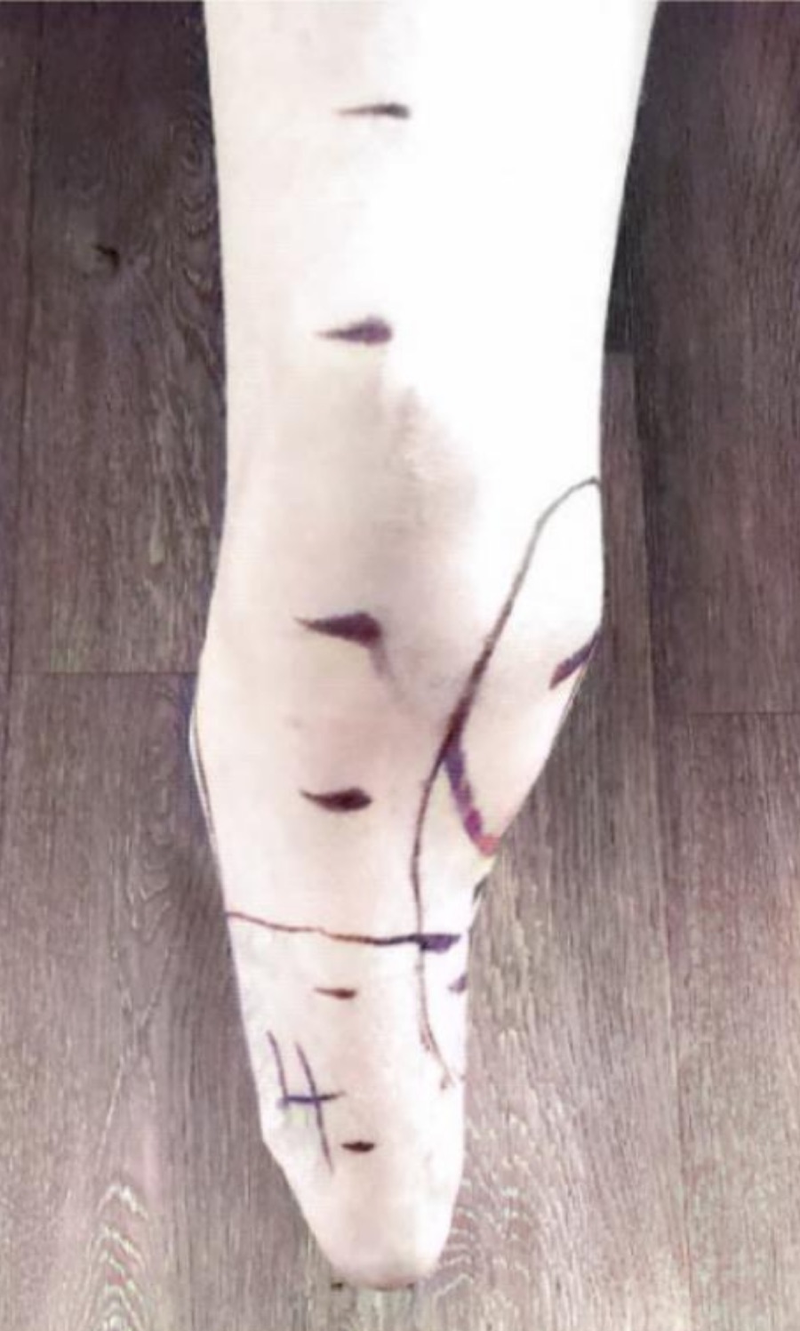 Prominent Condyle &mdash; Limb