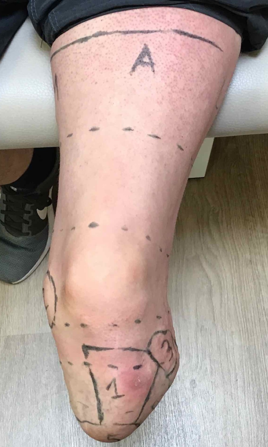 Prominent Fibula &mdash; Limb
