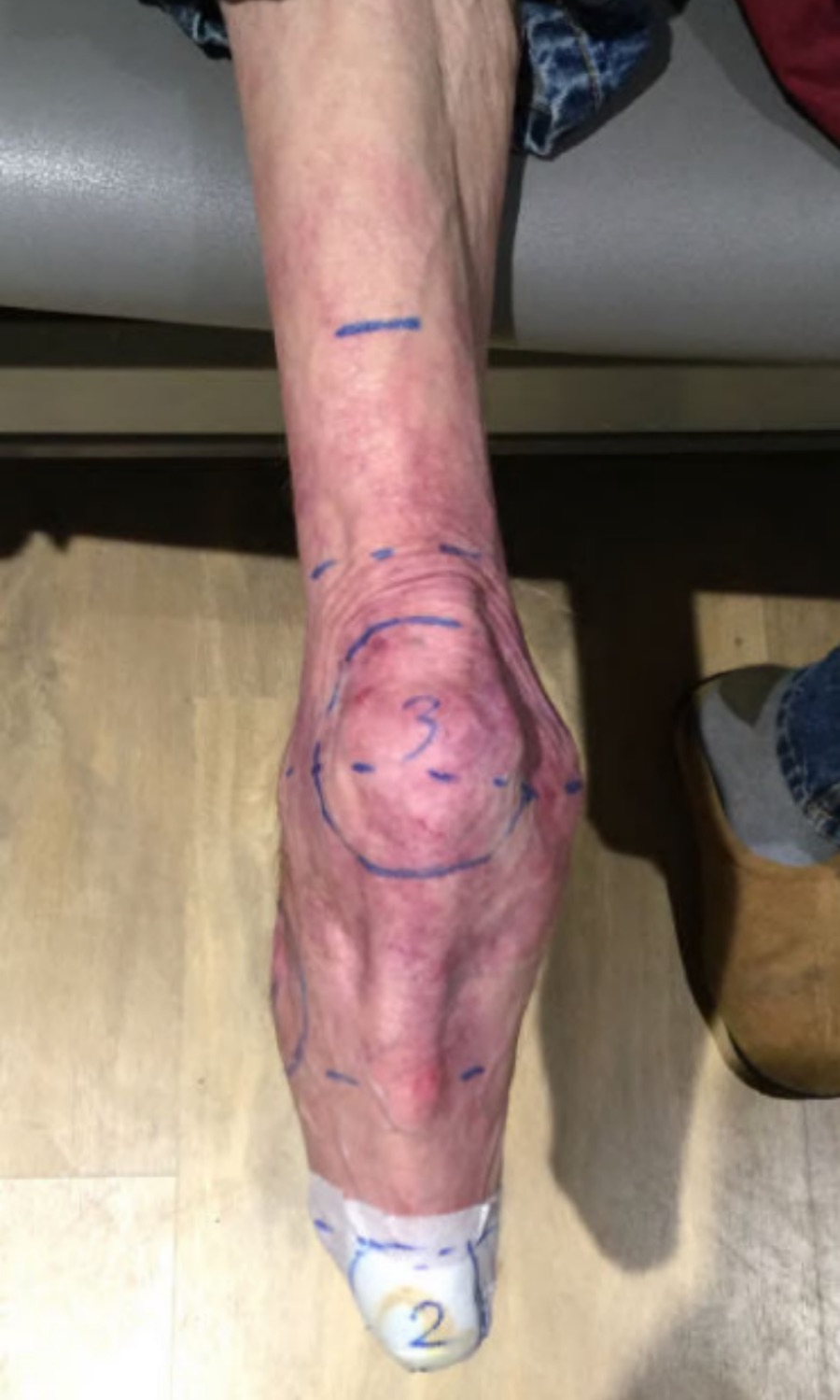 Thin Thigh &mdash; Limb