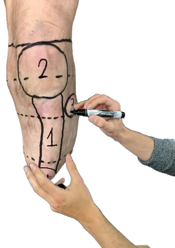 Drawing zones directly on the limb during the fitting